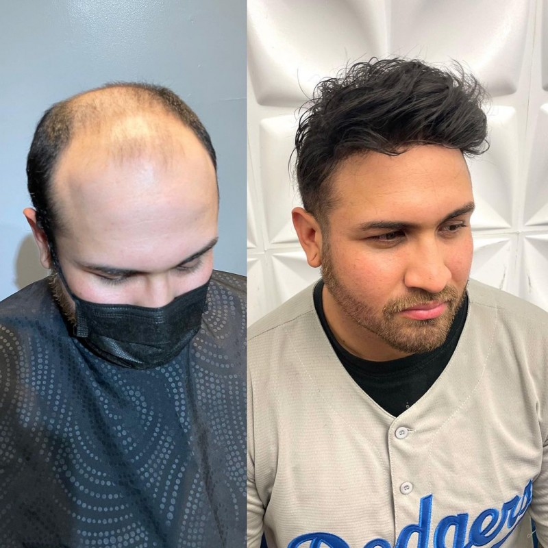 Toupee vs best sale bald